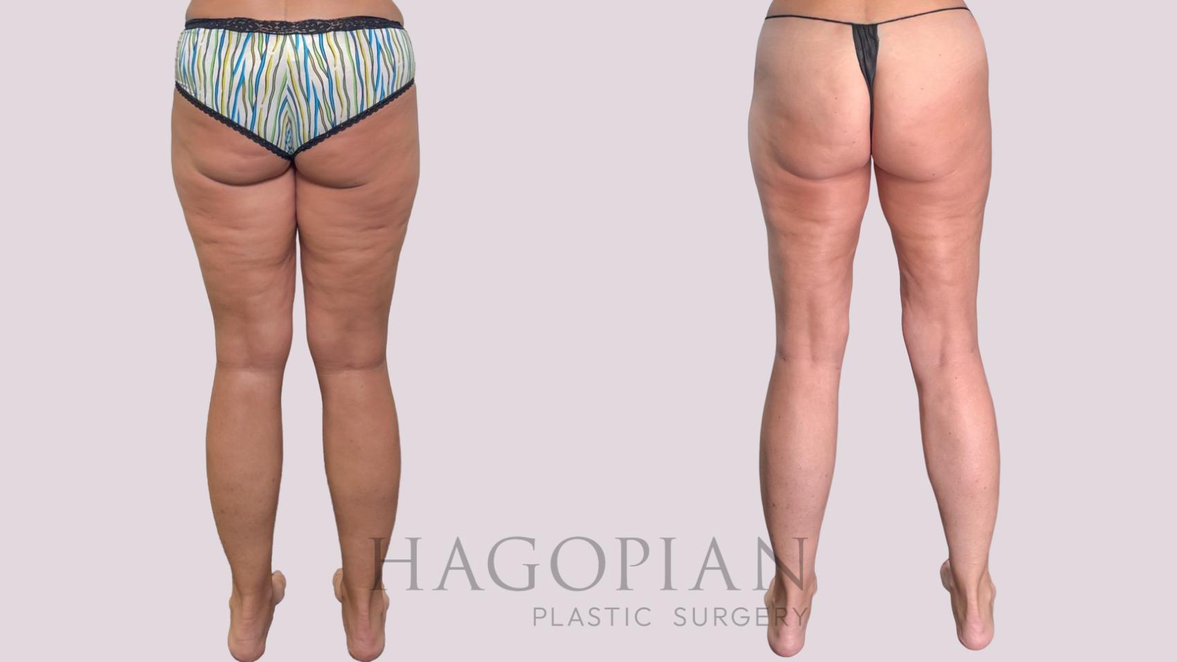 Before & After Liposuction Case 287 Back View in Atlanta, GA