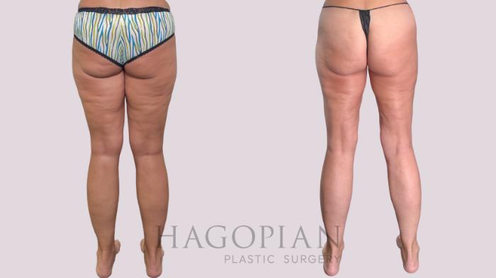 Before & After Liposuction Case 287 Back View in Atlanta, GA