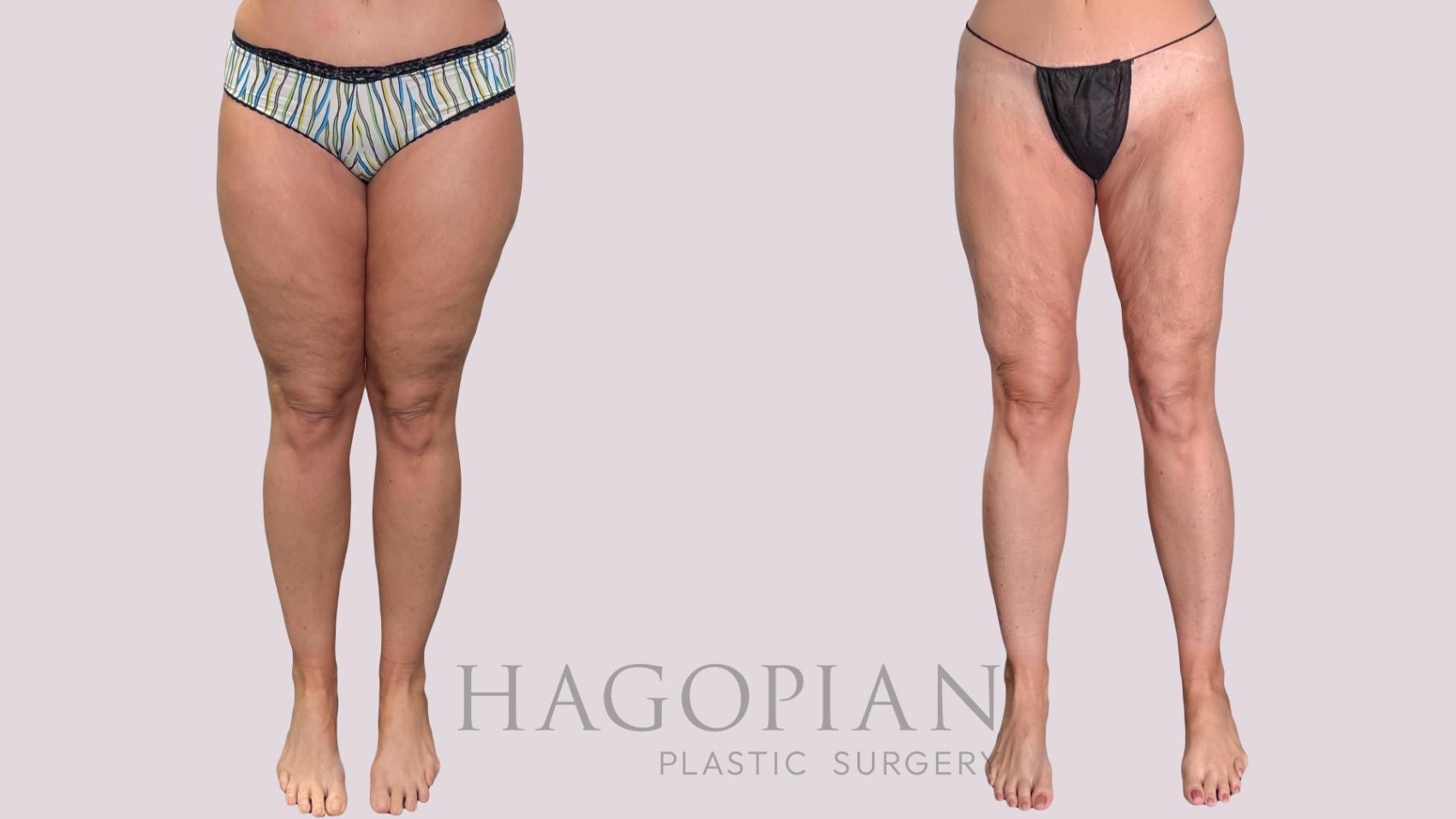 Before & After Liposuction Case 287 Front View in Atlanta, GA