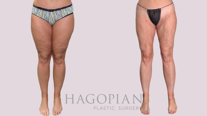 Before & After Liposuction Case 287 Front View in Atlanta, GA