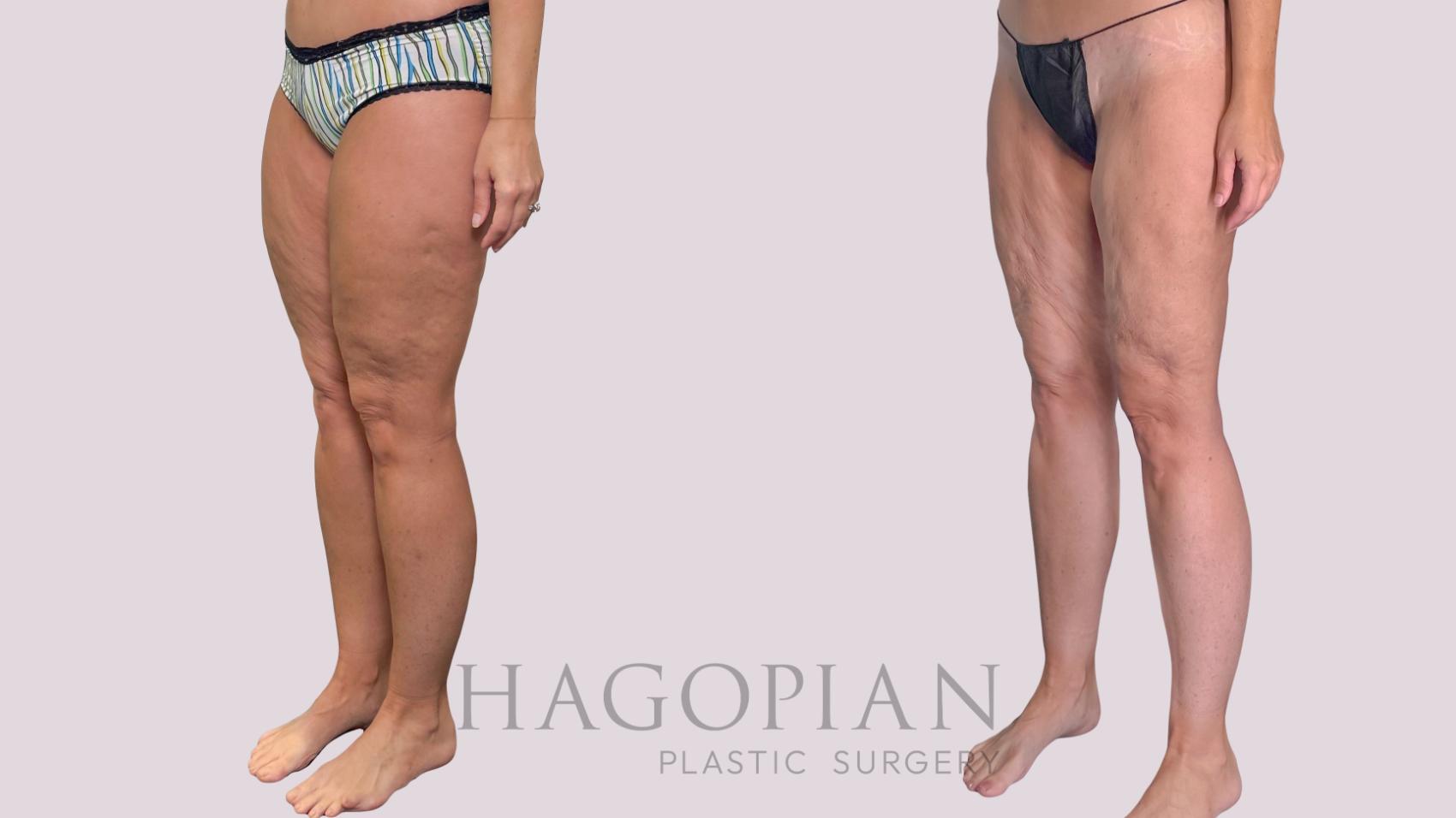 Before & After Liposuction Case 287 Left Oblique View in Atlanta, GA