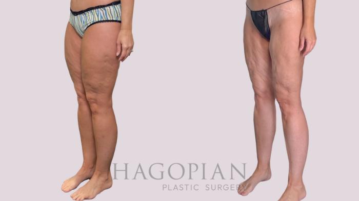 Before & After Liposuction Case 287 Left Oblique View in Atlanta, GA