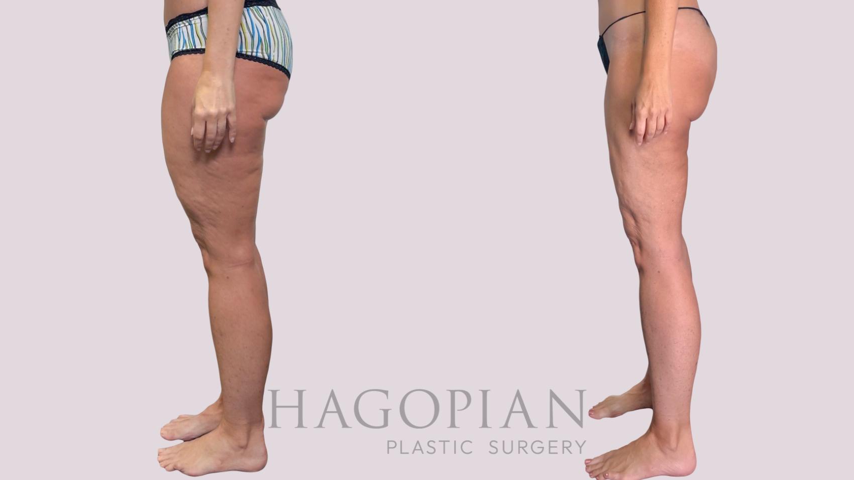 Before & After Liposuction Case 287 Left Side View in Atlanta, GA