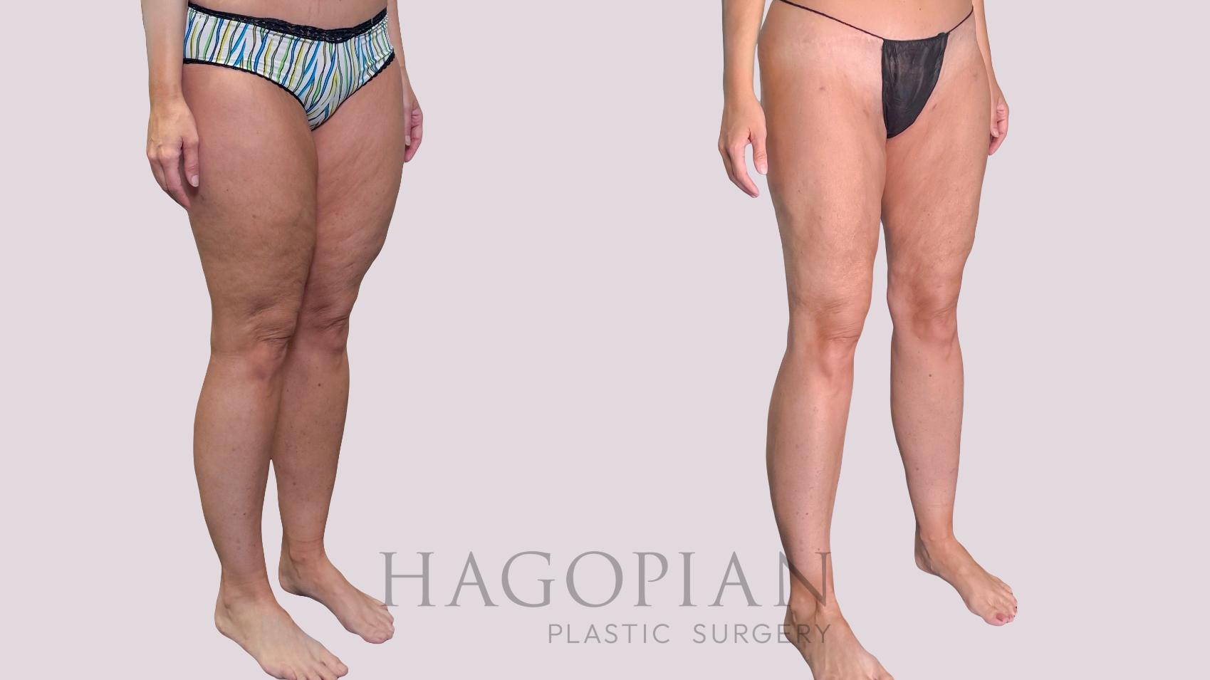 Before & After Liposuction Case 287 Right Oblique View in Atlanta, GA