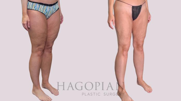 Before & After Liposuction Case 287 Right Oblique View in Atlanta, GA