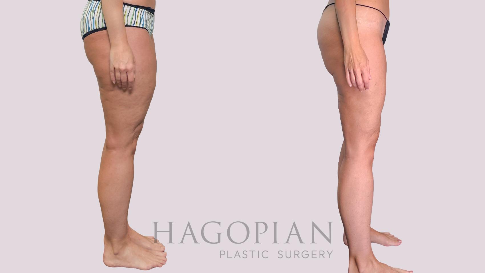 Before & After Liposuction Case 287 Right Side View in Atlanta, GA