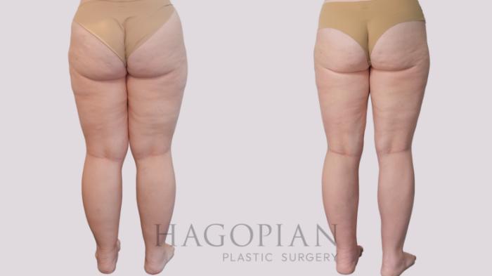 Before & After Liposuction Case 298 Back View in Atlanta, GA