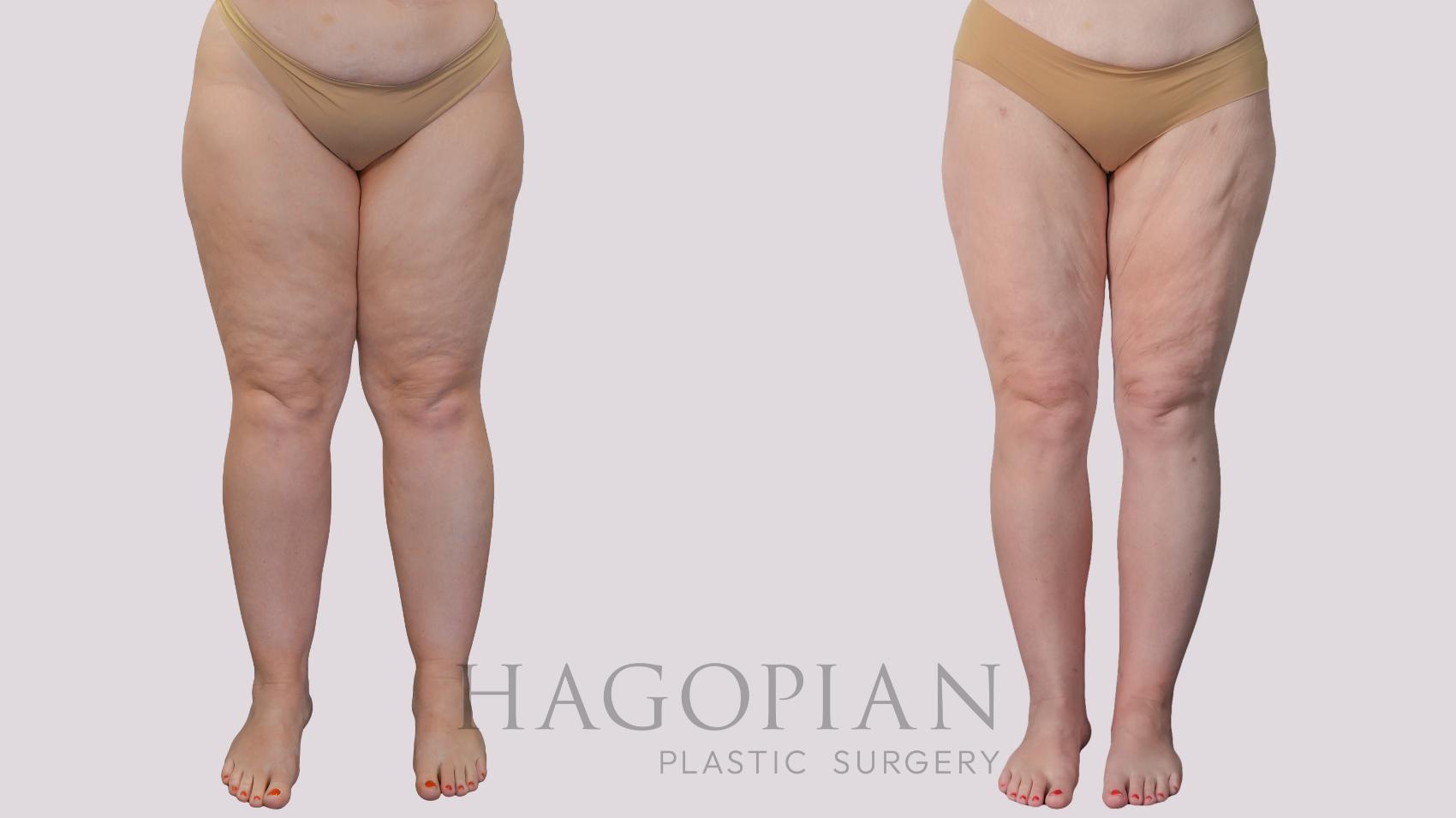 Before & After Liposuction Case 298 Front View in Atlanta, GA