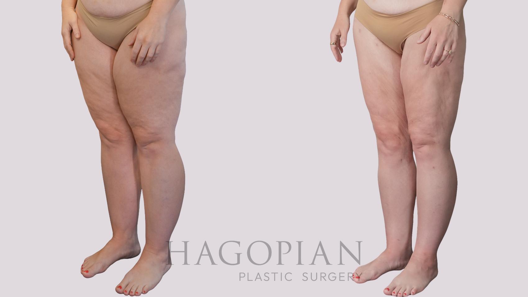 Before & After Liposuction Case 298 Left Oblique View in Atlanta, GA