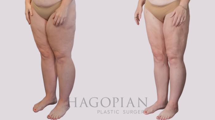 Before & After Liposuction Case 298 Left Oblique View in Atlanta, GA