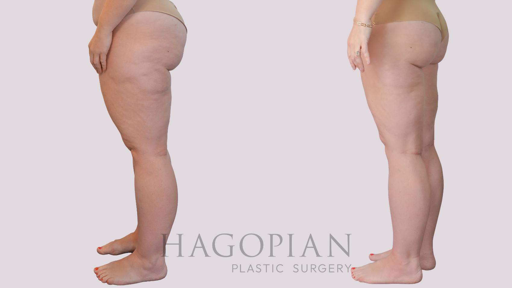 Before & After Liposuction Case 298 Left Side View in Atlanta, GA