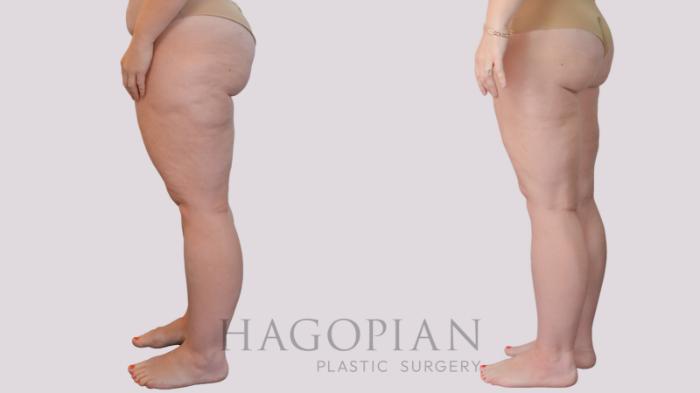 Before & After Liposuction Case 298 Left Side View in Atlanta, GA