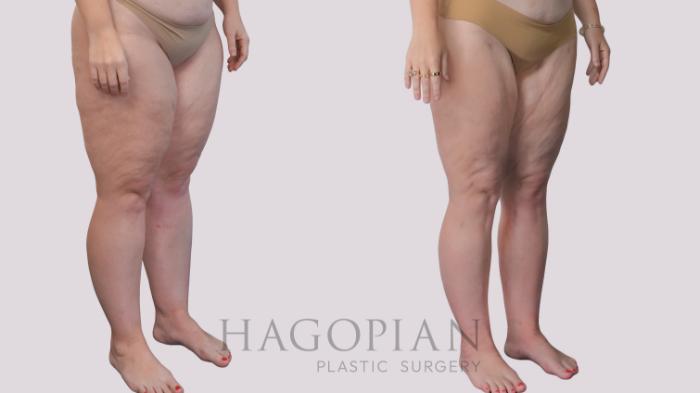 Before & After Liposuction Case 298 Right Oblique View in Atlanta, GA