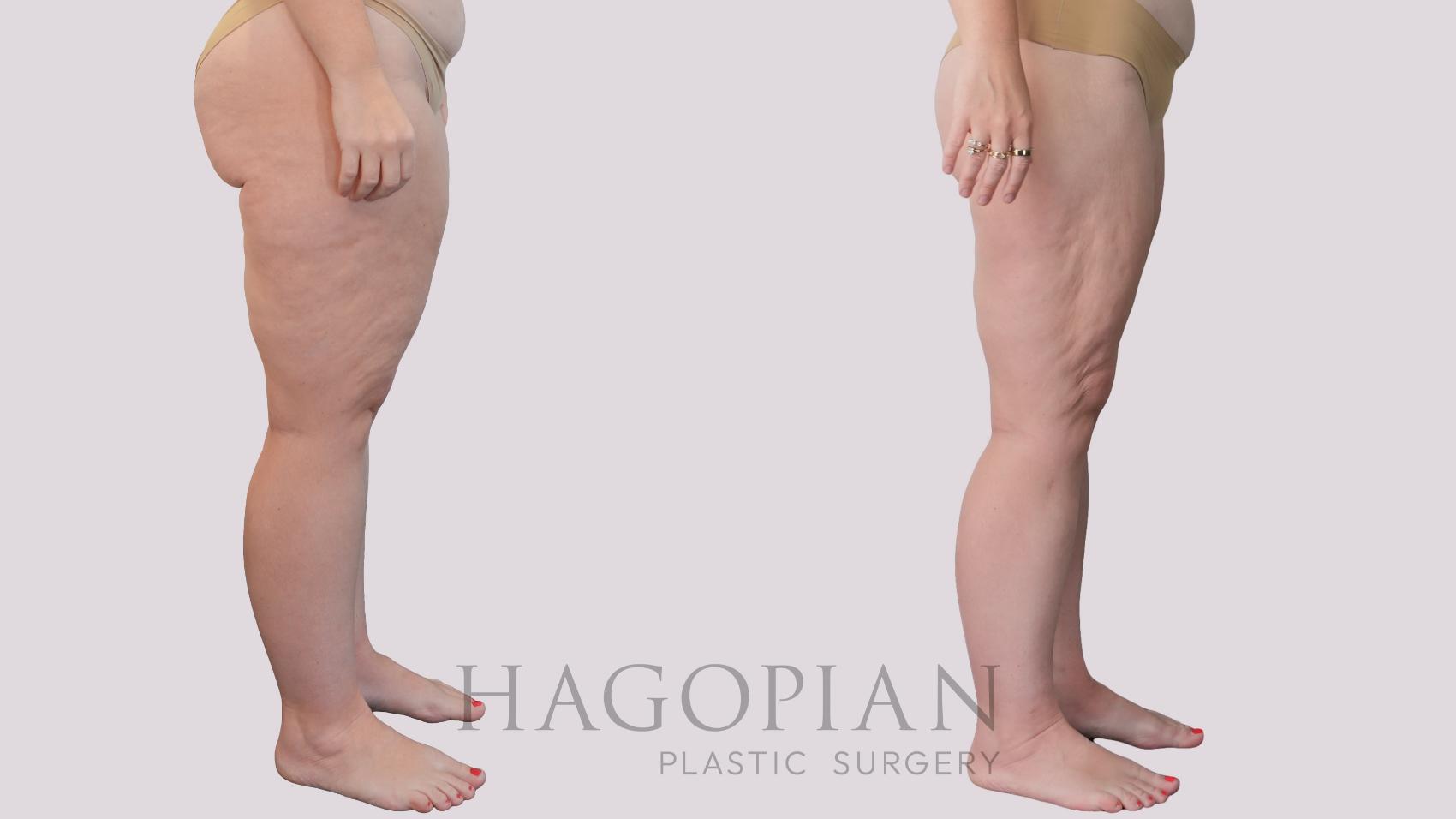 Before & After Liposuction Case 298 Right Side View in Atlanta, GA