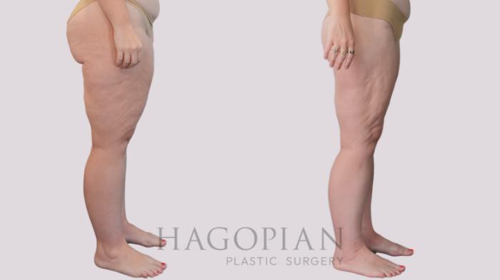 Before & After Liposuction Case 298 Right Side View in Atlanta, GA