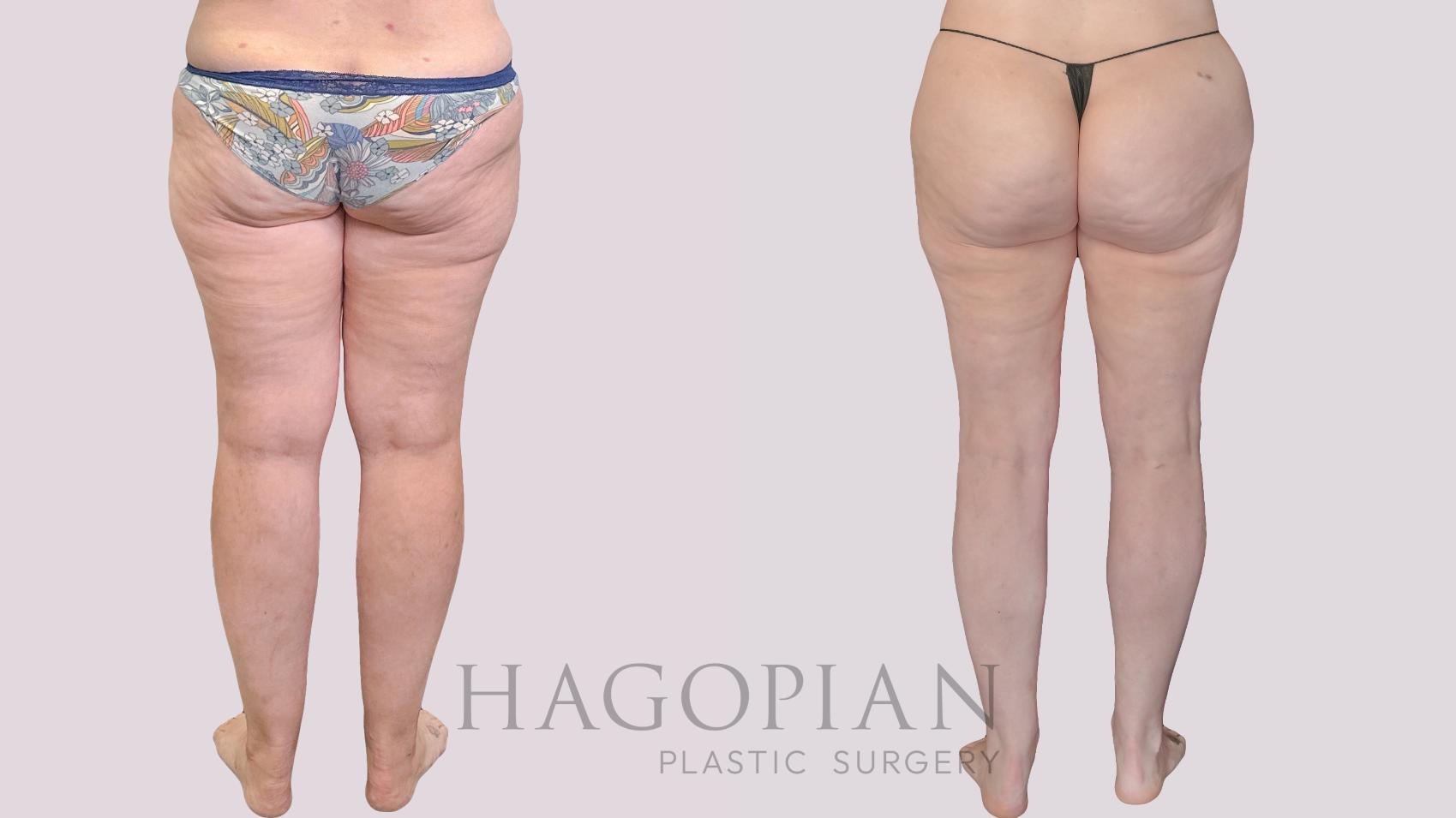 Before & After Liposuction Case 299 Back View in Atlanta, GA