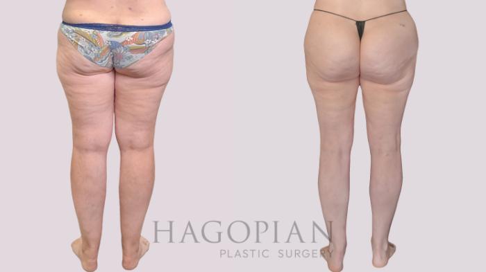 Before & After Liposuction Case 299 Back View in Atlanta, GA