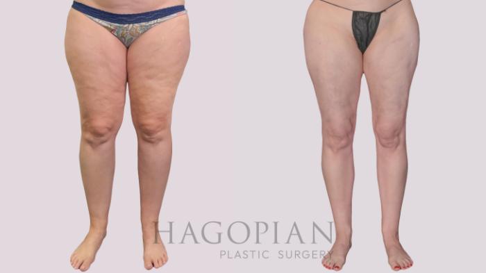 Before & After Liposuction Case 299 Front View in Atlanta, GA