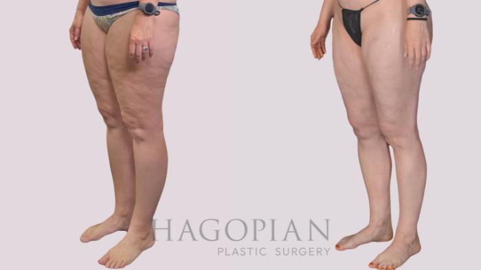 Before & After Liposuction Case 299 Left Oblique View in Atlanta, GA