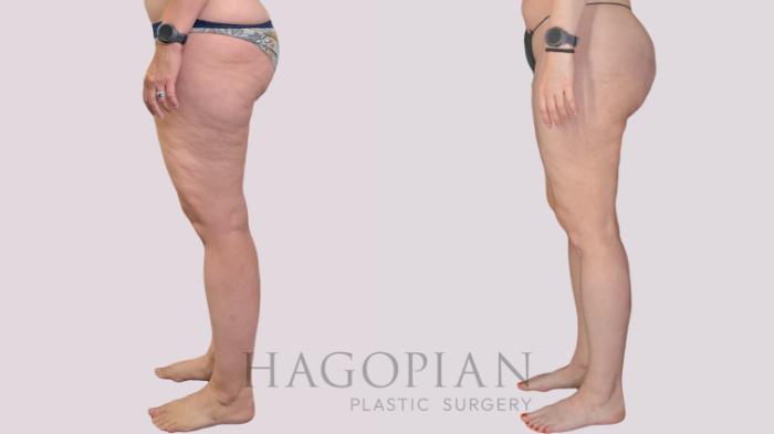 Before & After Liposuction Case 299 Left Side View in Atlanta, GA