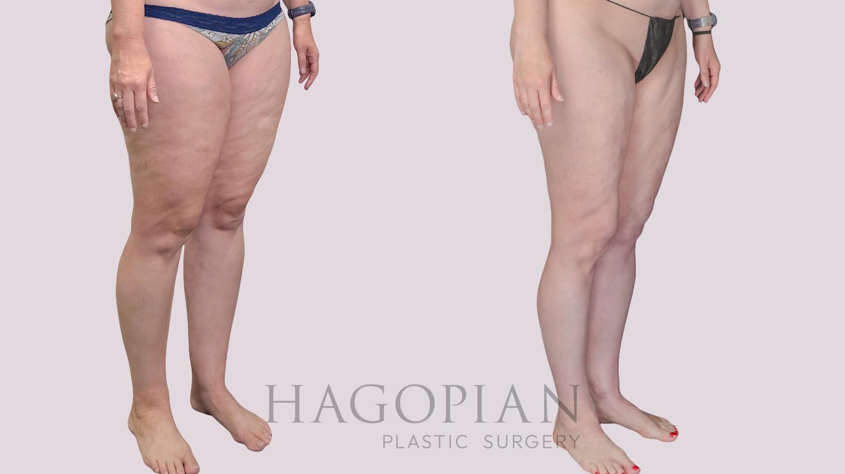 Before & After Liposuction Case 299 Right Oblique View in Atlanta, GA