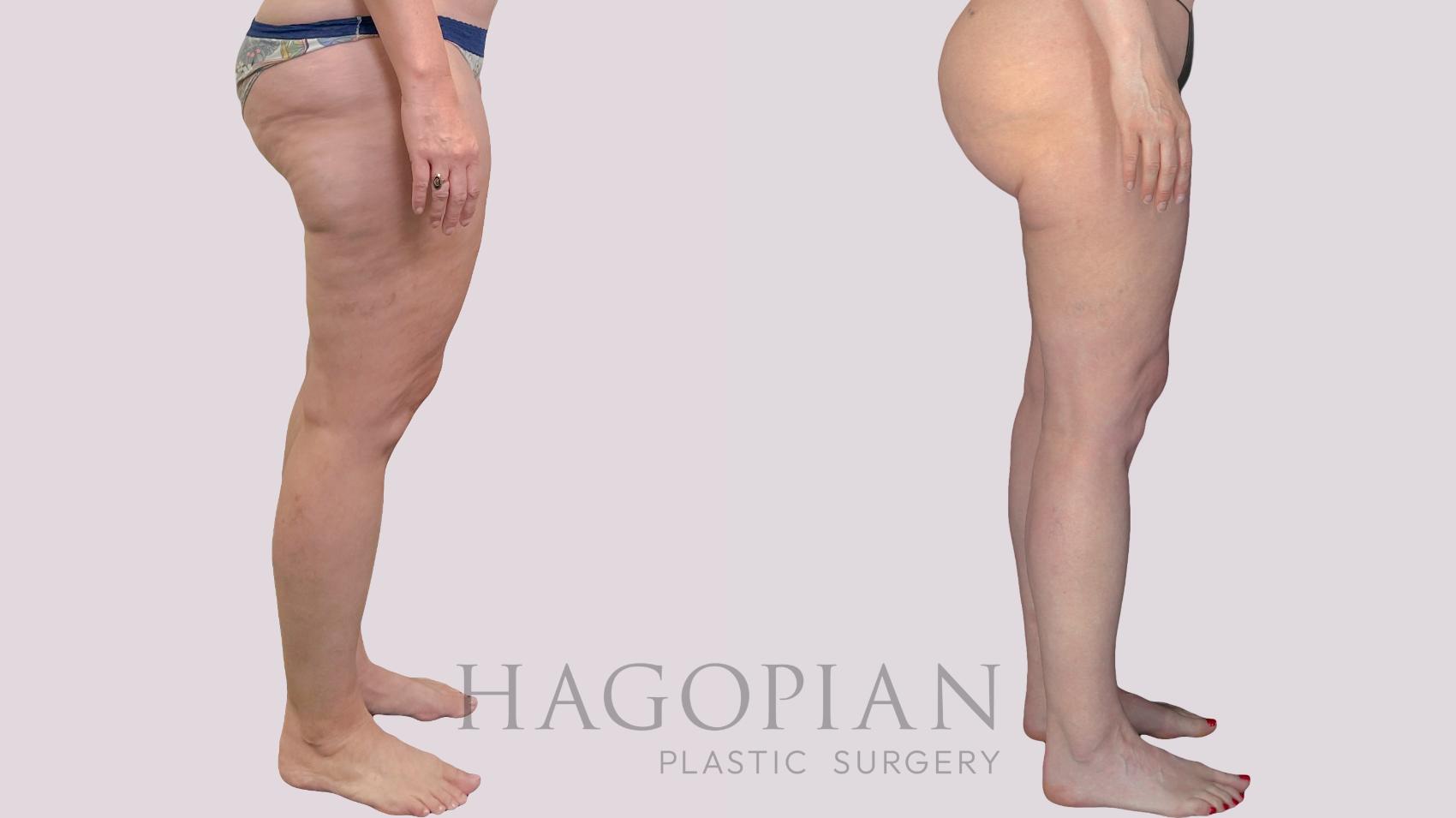 Before & After Liposuction Case 299 Right Side View in Atlanta, GA