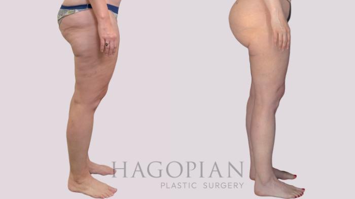 Before & After Liposuction Case 299 Right Side View in Atlanta, GA