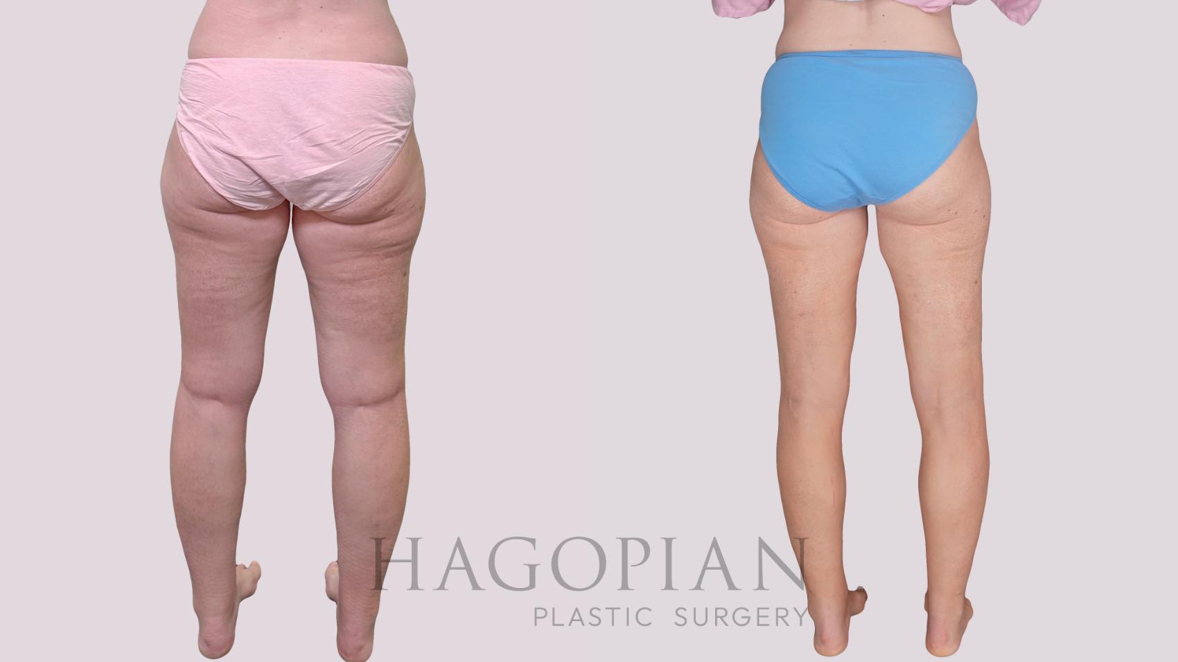 Before & After Liposuction Case 306 Back View in Atlanta, GA