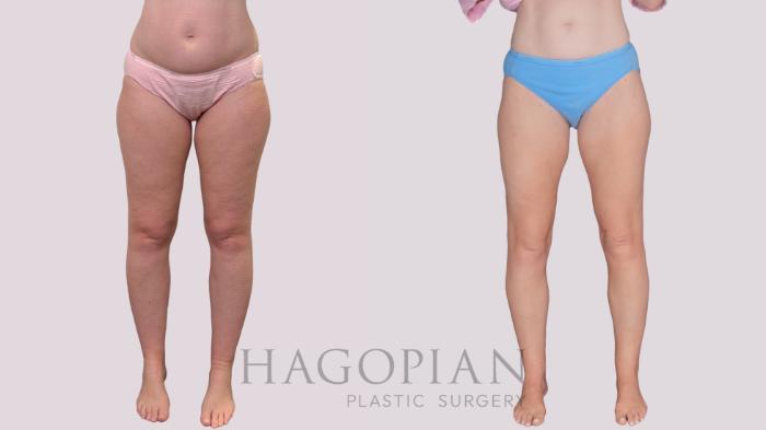 Before & After Liposuction Case 306 Front View in Atlanta, GA