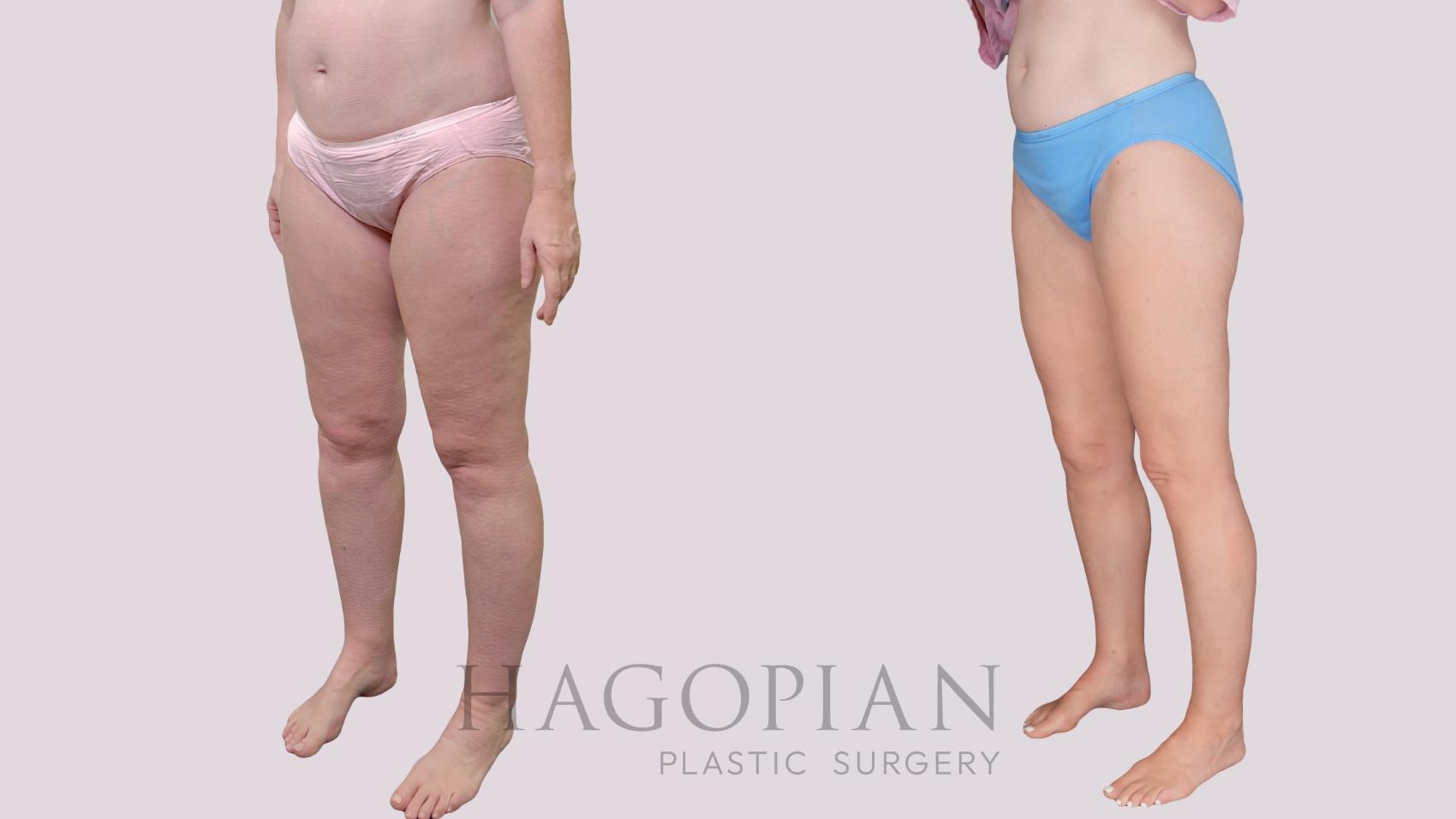 Before & After Liposuction Case 306 Left Oblique View in Atlanta, GA