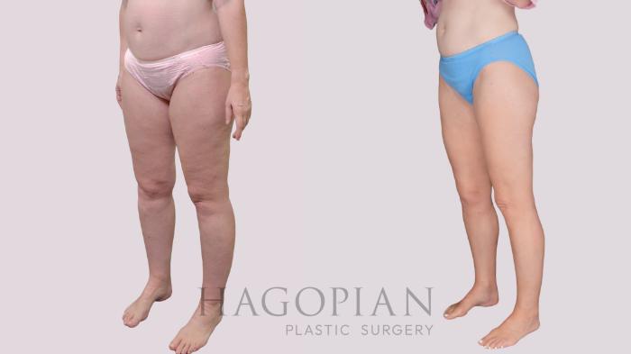 Before & After Liposuction Case 306 Left Oblique View in Atlanta, GA