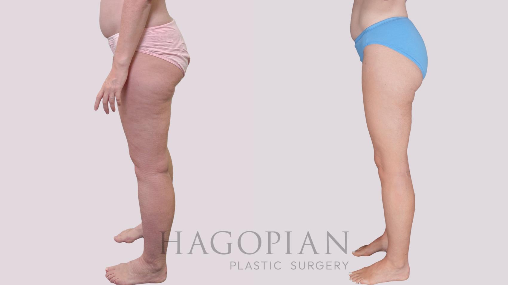 Before & After Liposuction Case 306 Left Side View in Atlanta, GA