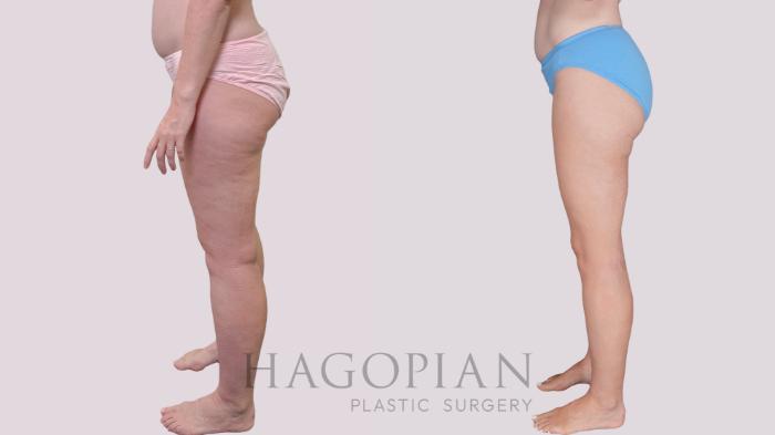 Before & After Liposuction Case 306 Left Side View in Atlanta, GA