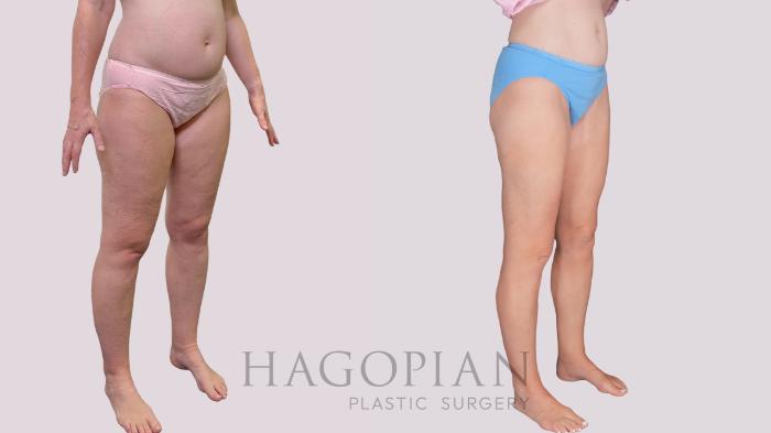 Before & After Liposuction Case 306 Right Oblique View in Atlanta, GA