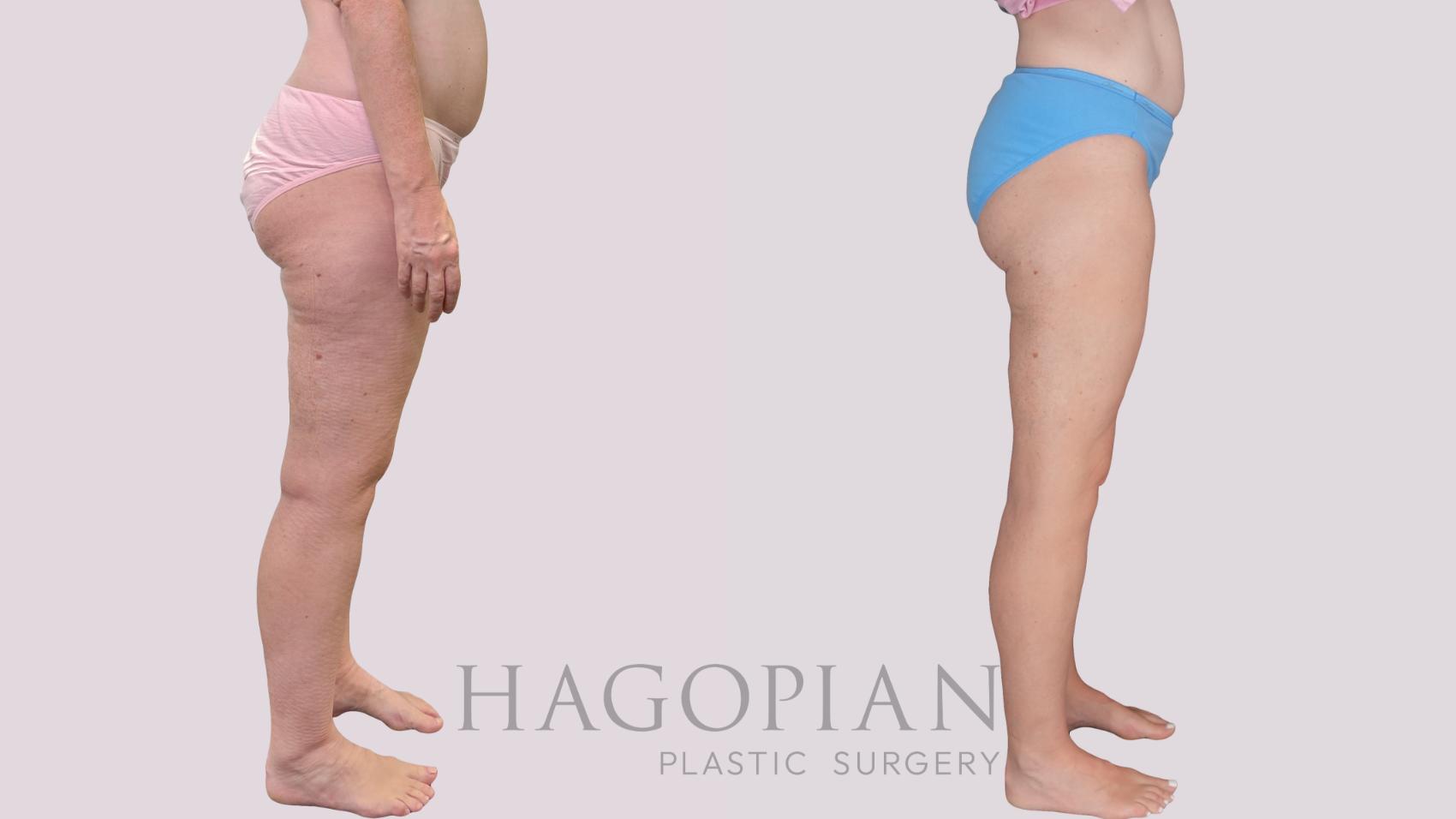 Before & After Liposuction Case 306 Right Side View in Atlanta, GA