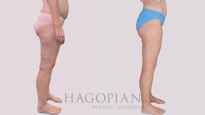 Before & After Liposuction Case 306 Right Side View in Atlanta, GA