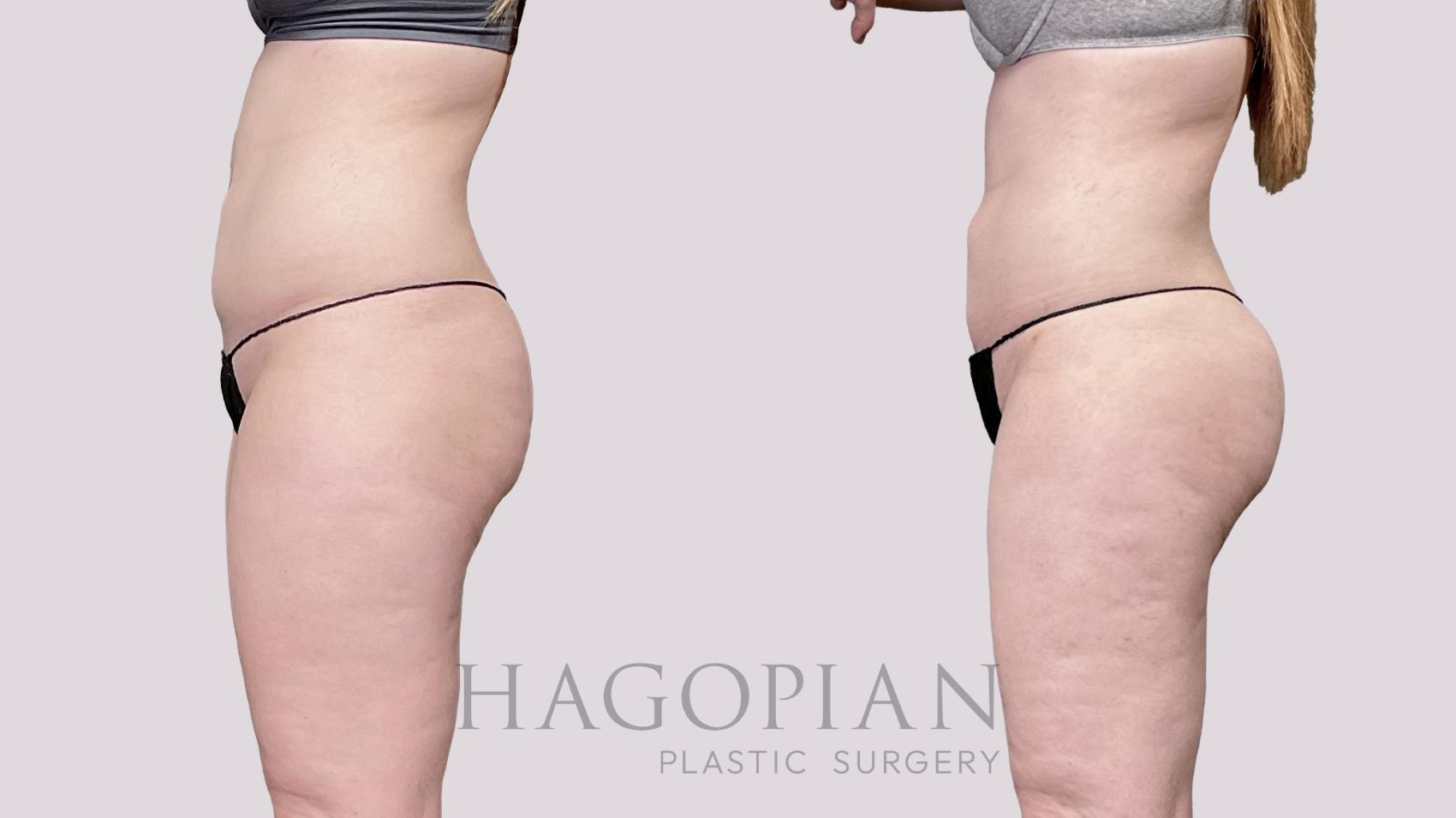 Before & After Liposuction Case 56 Left Side View in Atlanta, GA