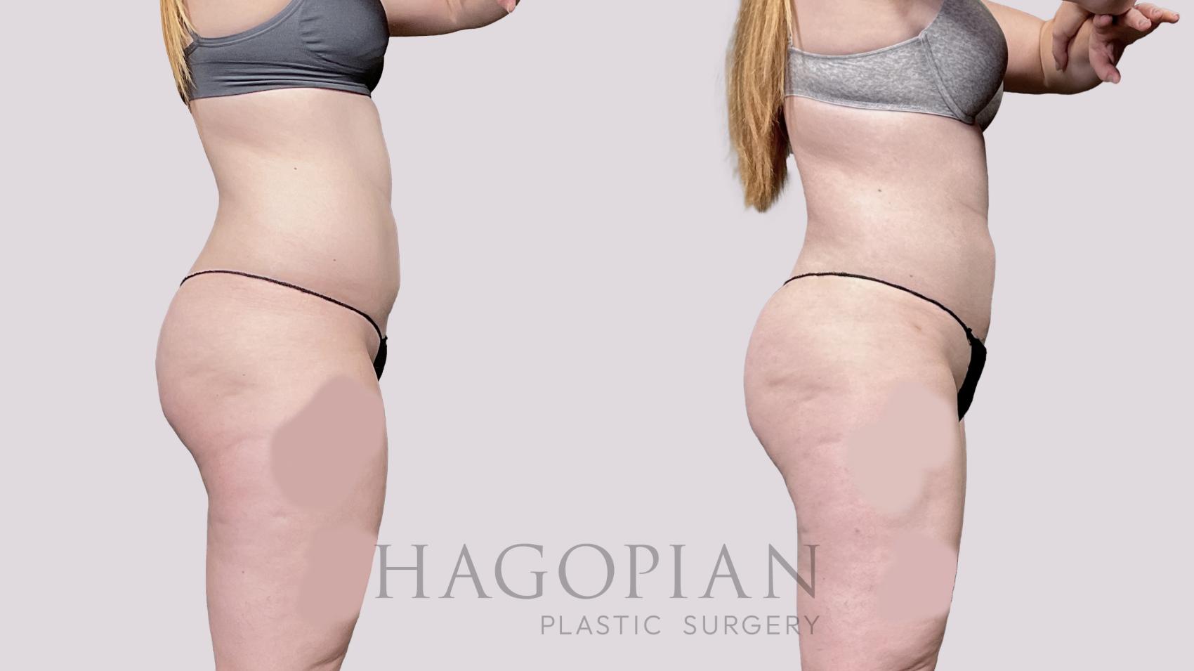 Before & After Liposuction Case 56 Right Side View in Atlanta, GA