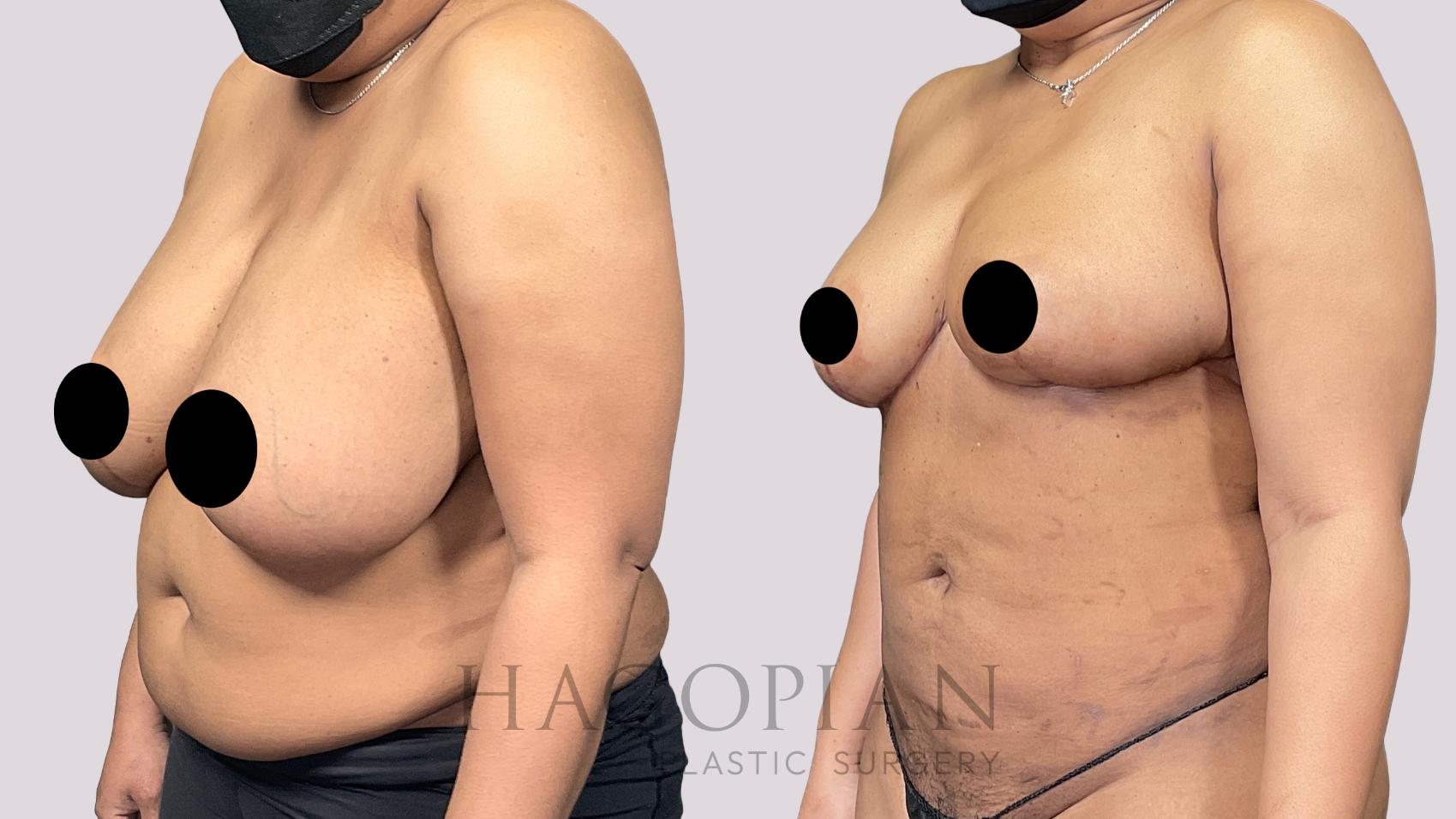 Before & After Liposuction Case 59 Left Oblique View in Atlanta, GA