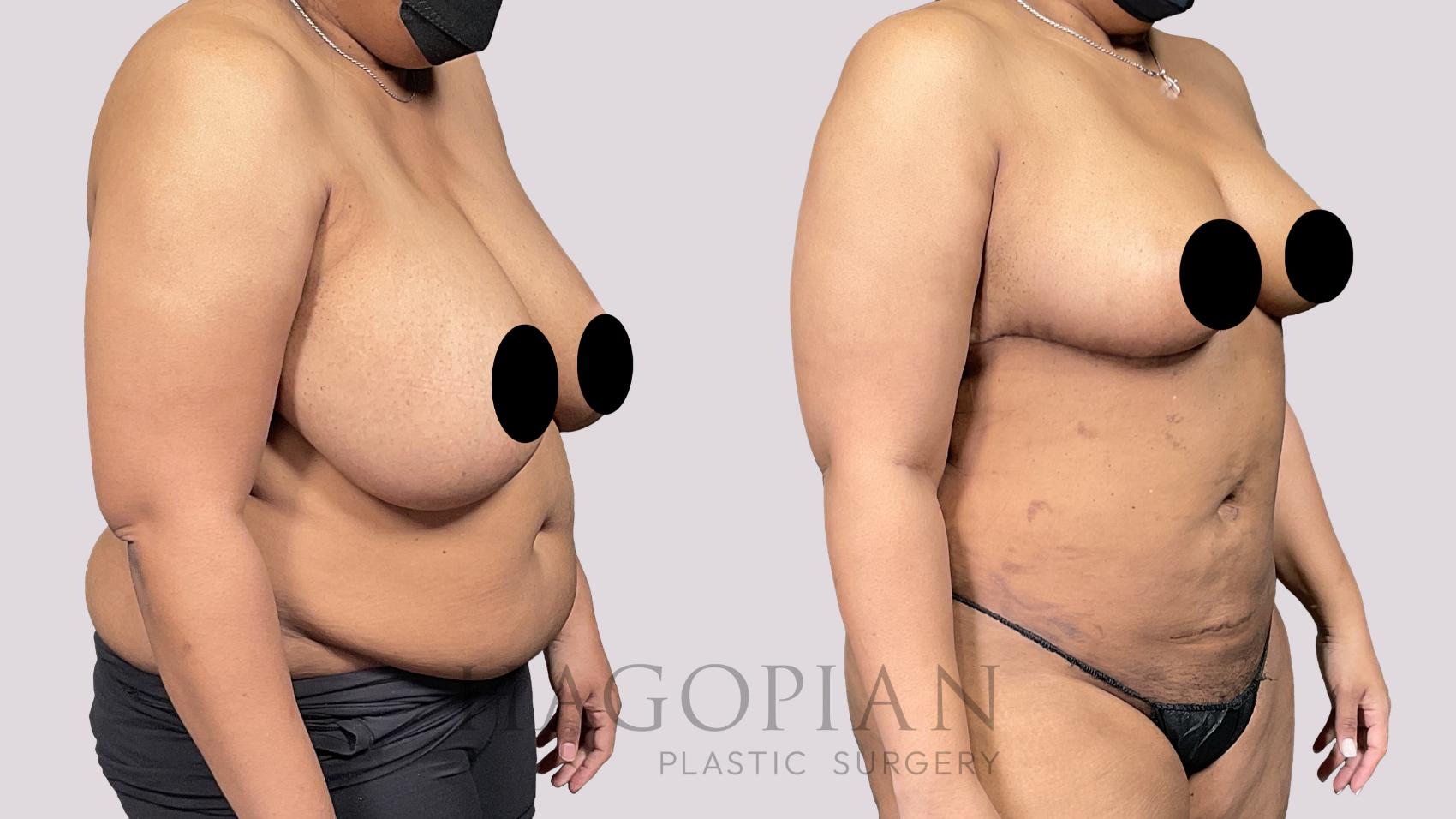 Before & After Liposuction Case 59 Right Oblique View in Atlanta, GA