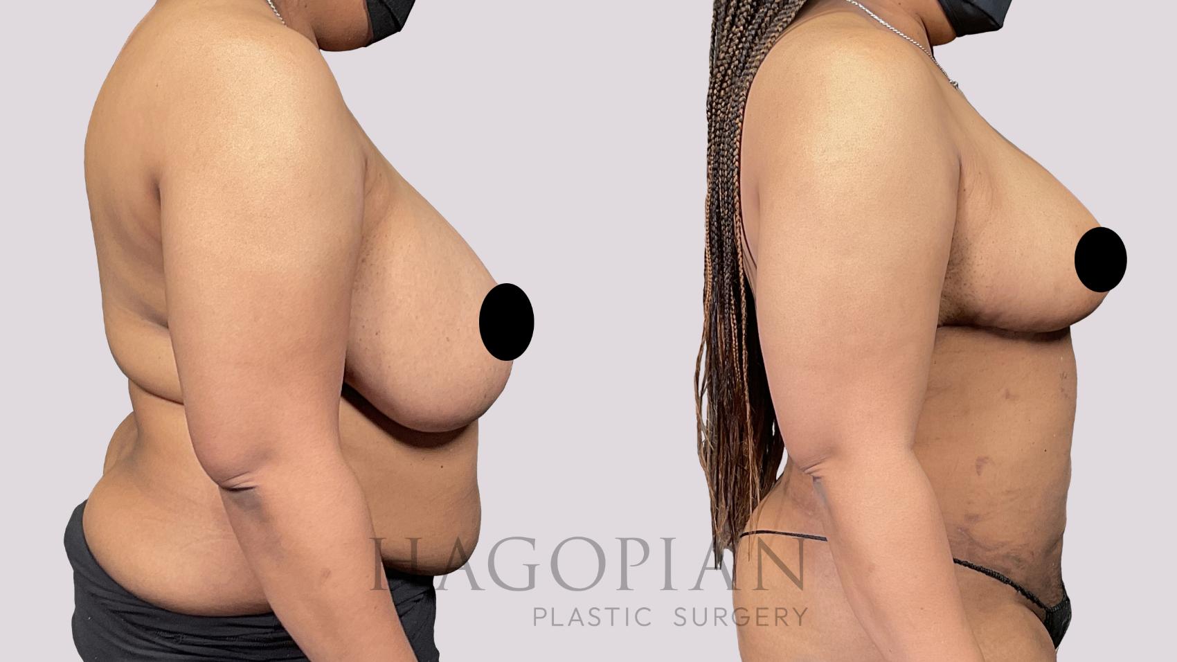 Before & After Liposuction Case 59 Right Side View in Atlanta, GA