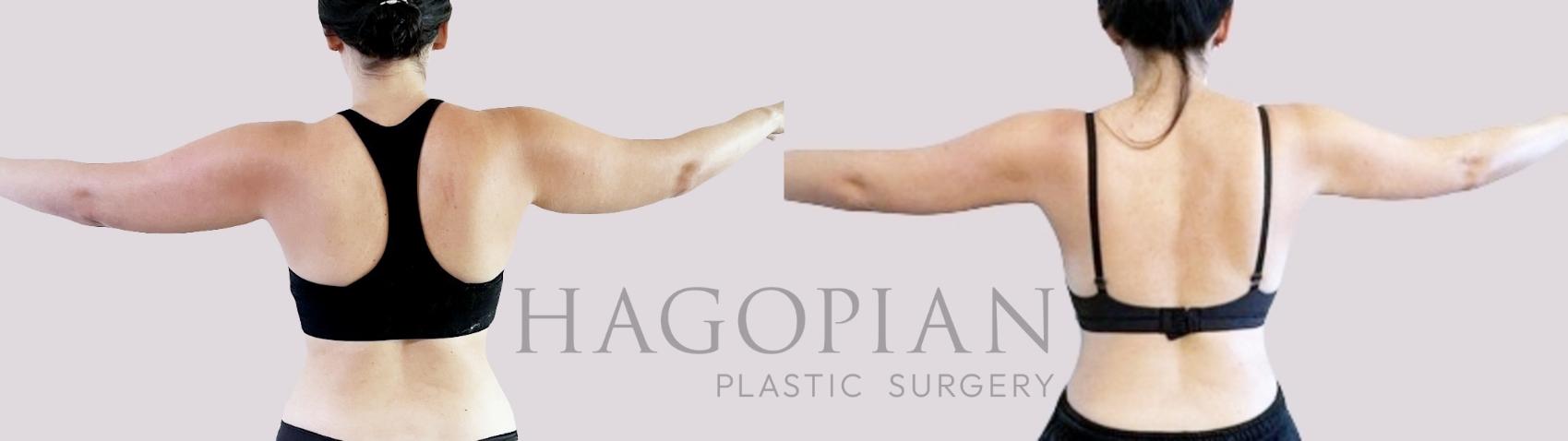 Before & After Liposuction Case 99 Back View in Atlanta, GA