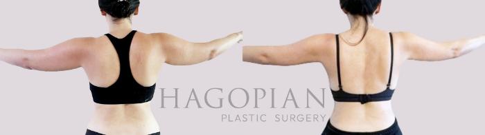 Before & After Liposuction Case 99 Back View in Atlanta, GA