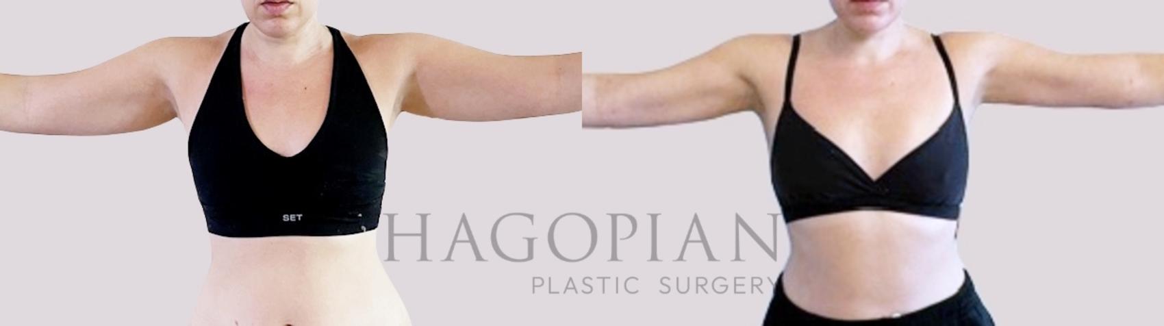 Before & After Liposuction Case 99 Front View in Atlanta, GA