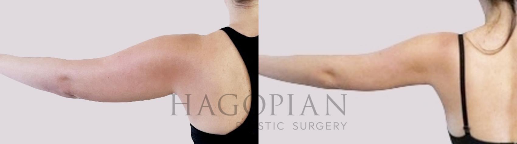 Before & After Liposuction Case 99 Left Side View in Atlanta, GA