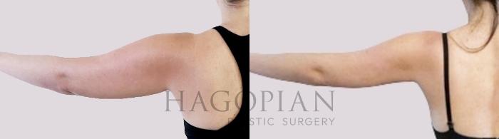 Before & After Liposuction Case 99 Left Side View in Atlanta, GA