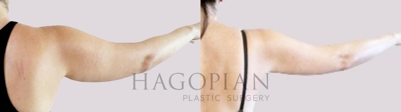 Before & After Liposuction Case 99 Right Side View in Atlanta, GA
