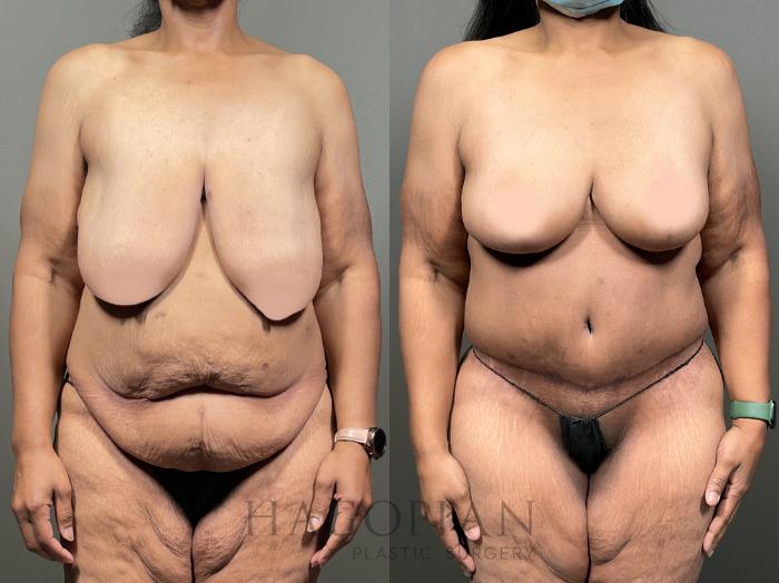Before & After Breast Reduction Case 49 Front View in Atlanta, GA