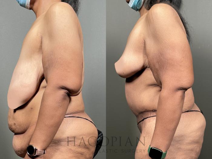Before & After Breast Reduction Case 49 Left Side View in Atlanta, GA