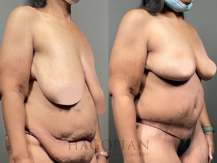 Before & After Breast Reduction Case 49 Right Oblique View in Atlanta, GA